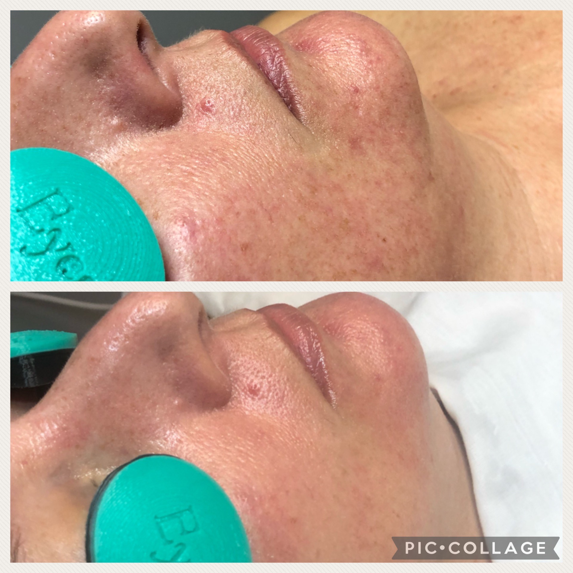 Rezenerate Facial (Before/After)